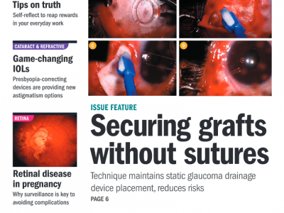 Laser trabeculoplasty opening doors for open-angle glaucoma patients – Ophthalmology Times Europe June 2017